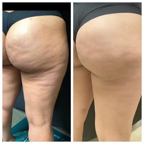 Customer photo review of Legging anti-cellulite Sleemz™