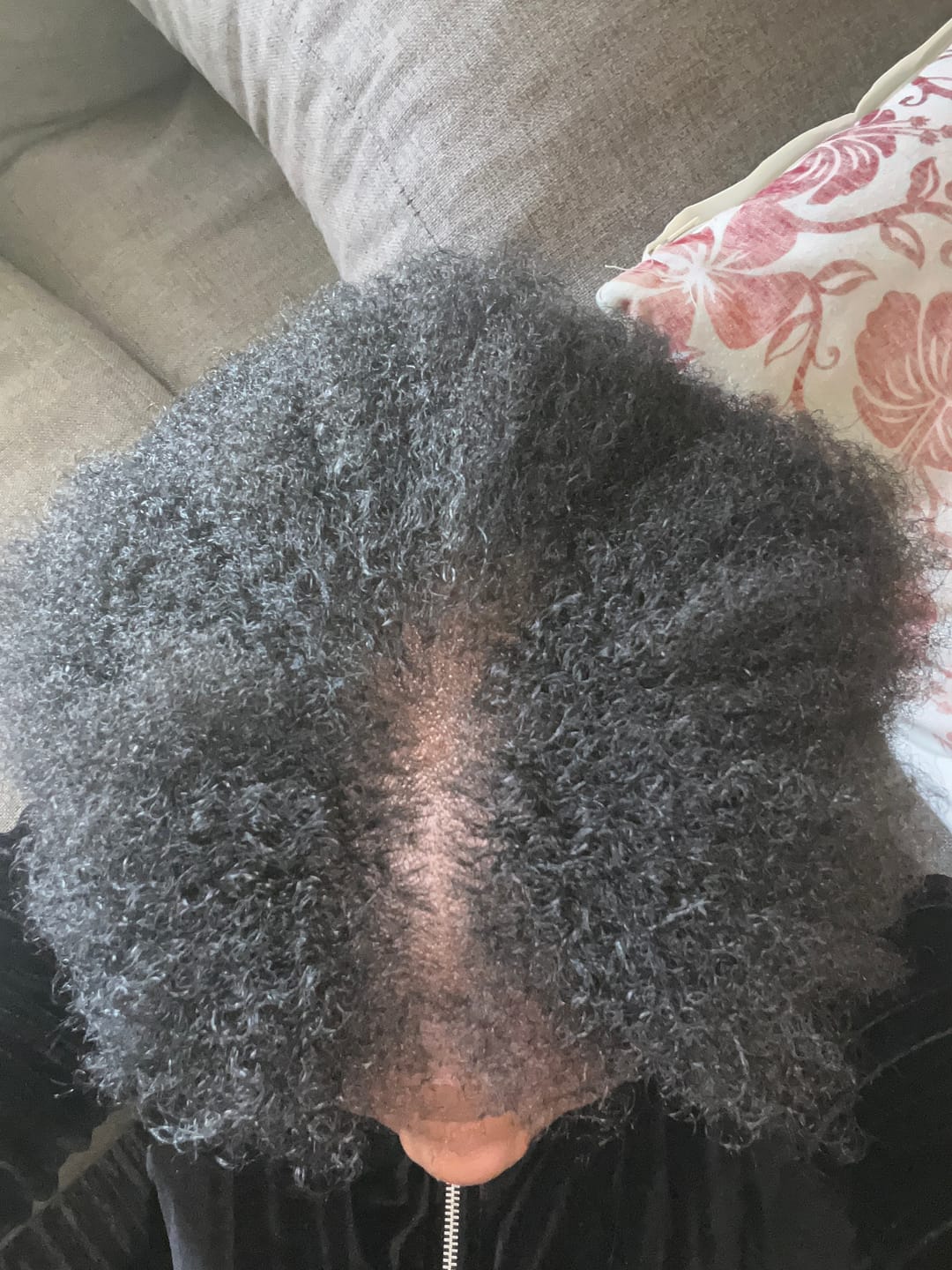 Customer photo review of Minoxidil High Strength (5%) SOLUTION, 3x60ml pack
