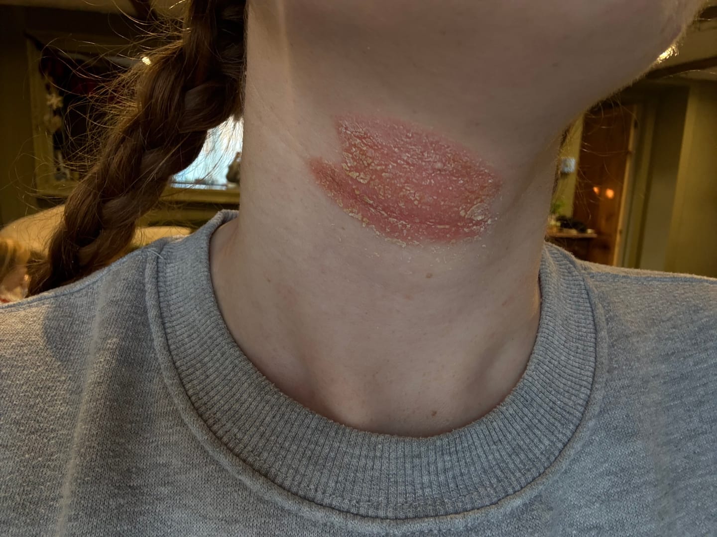 Customer photo review of Herbal Psoriasis Relief Cream