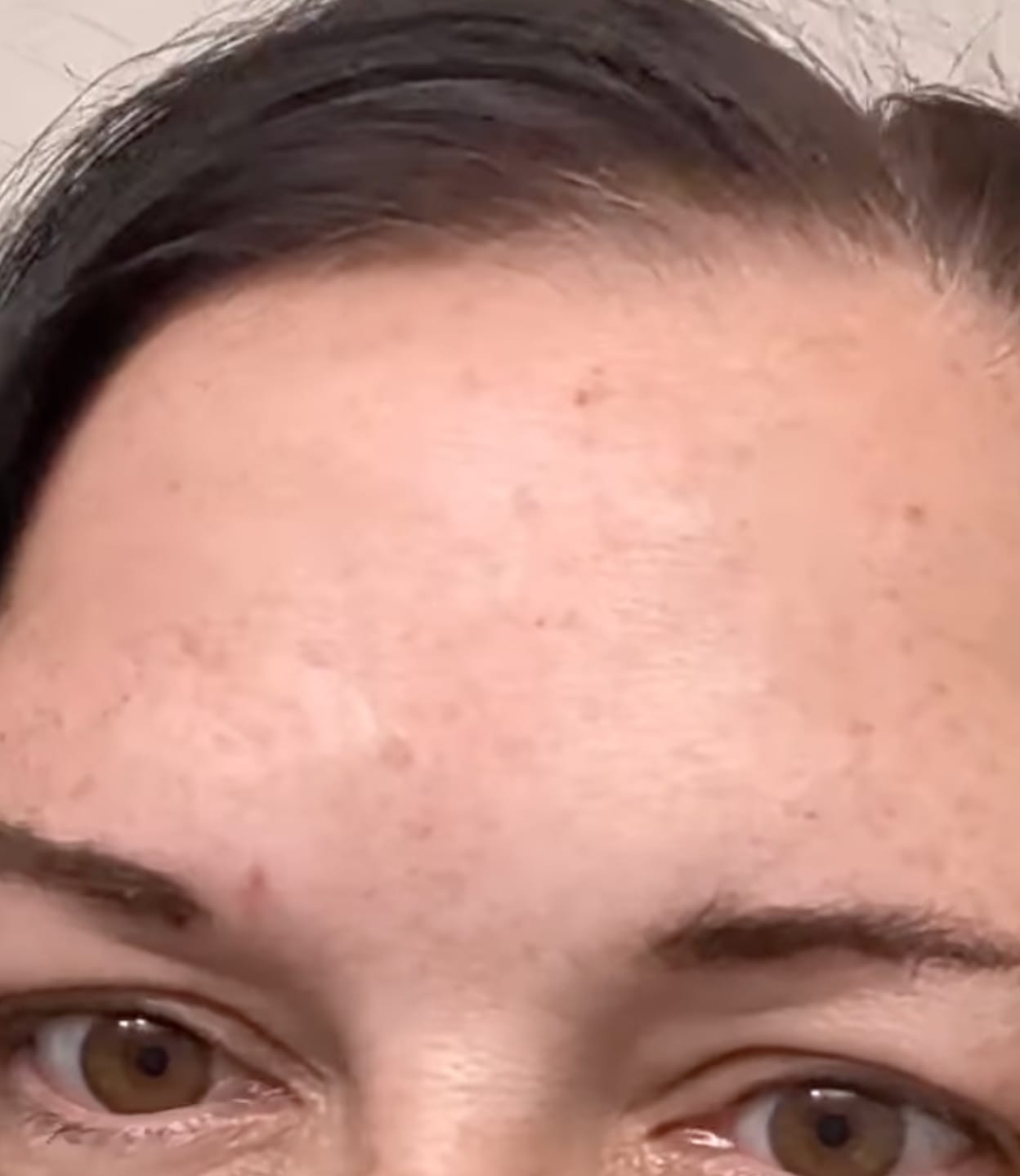 Customer photo review of Patch Skinjection aux peptides — Visage & Contour des yeux