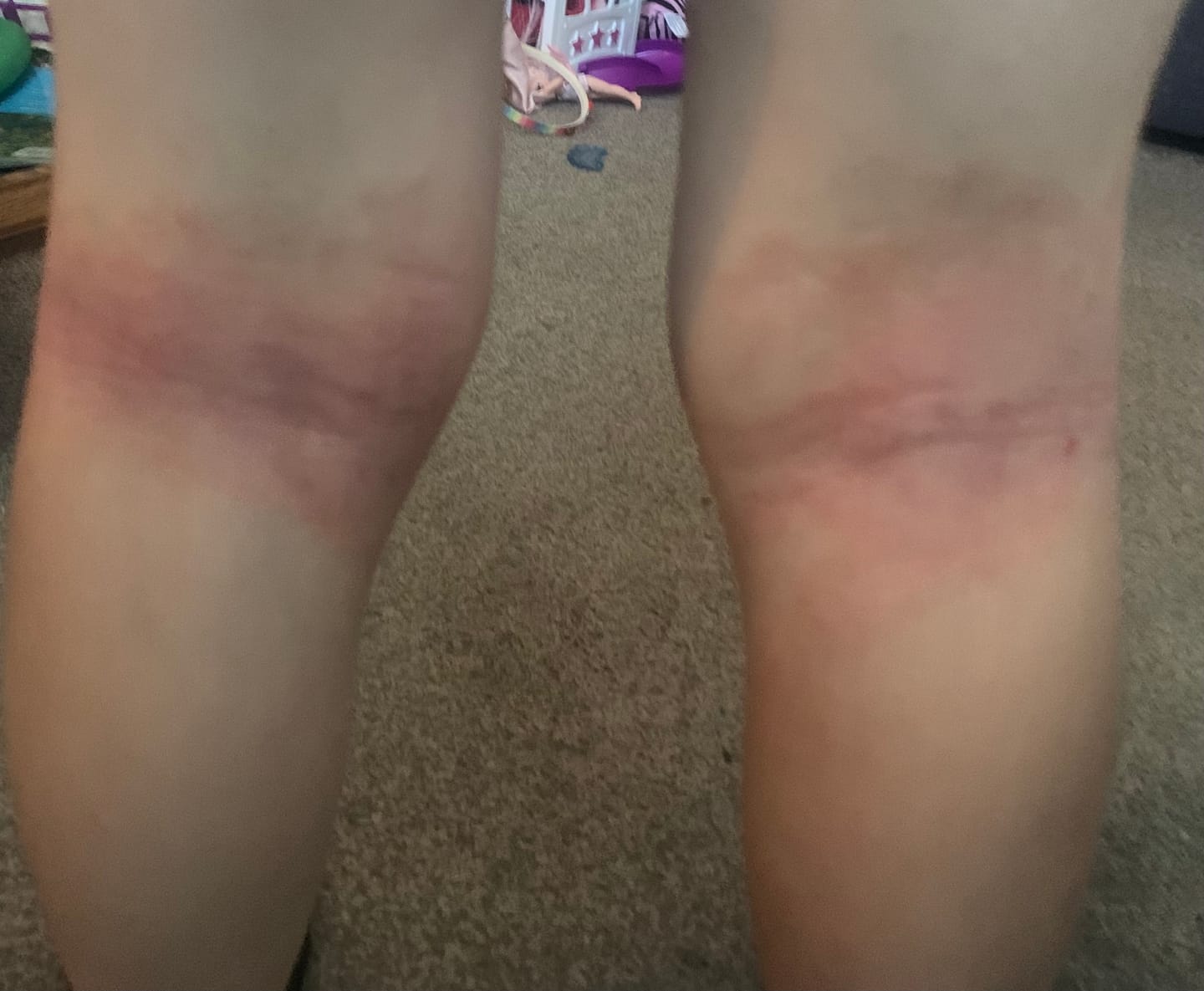 Customer photo review of Bioskin Junior Duo Pack