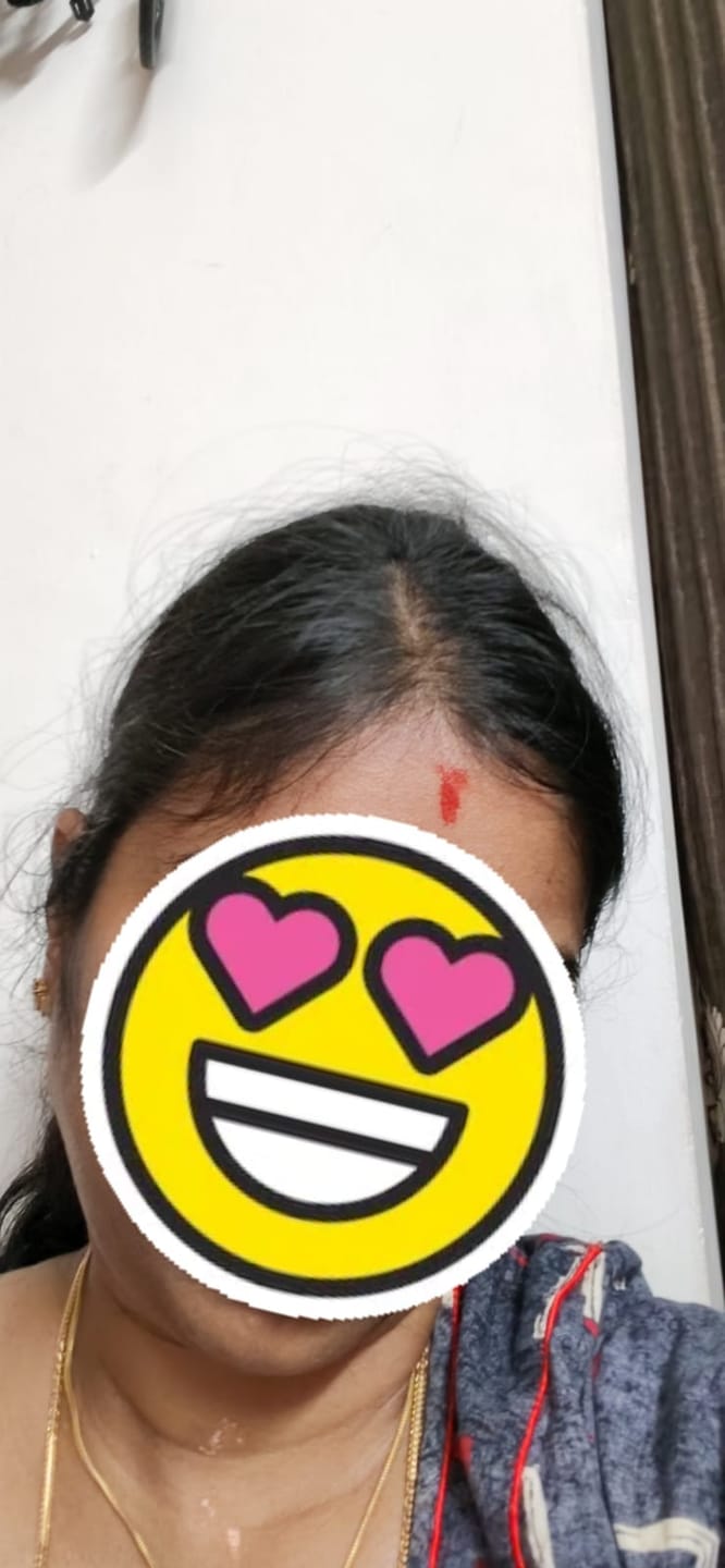 Customer photo review of Advance Hair Growth Serum 2.0 (30ml)