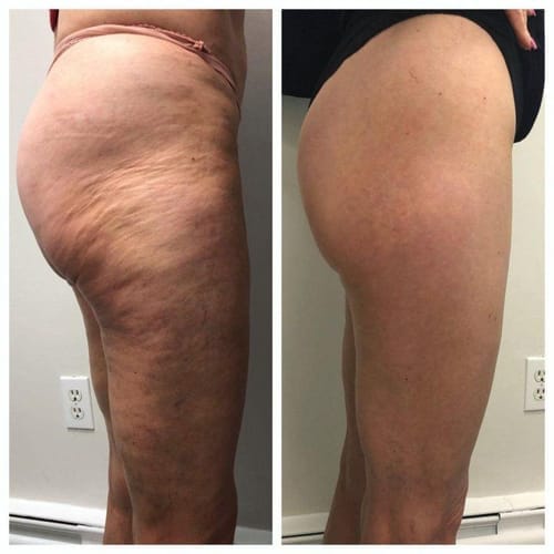 Customer photo review of Legging anti-cellulite Sleemz™