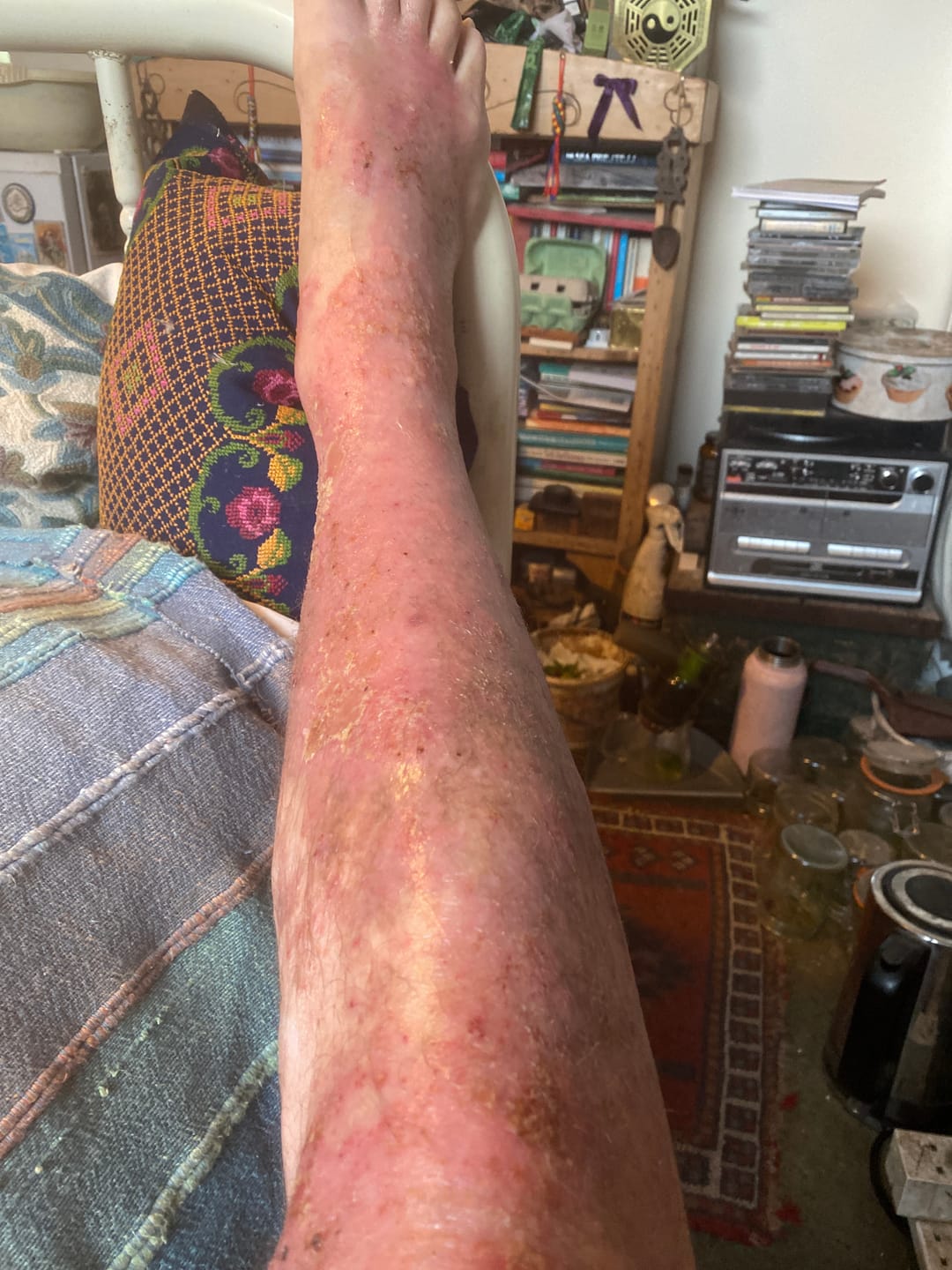 Customer photo review of Bioskin Zeoderm Skin Repair Moisturiser