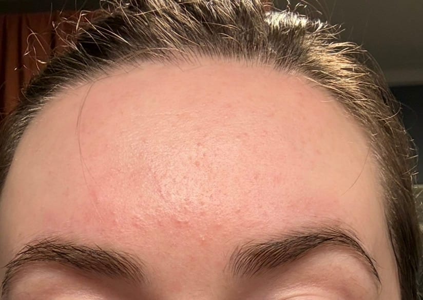 Customer photo review of NINE LESS Molecule-Clear Salicylic Acid Serum