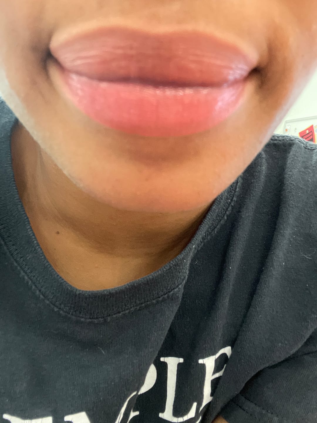 Customer photo review of Lips Lightening Cream For Men and Women (Results in 5 Days or Less)