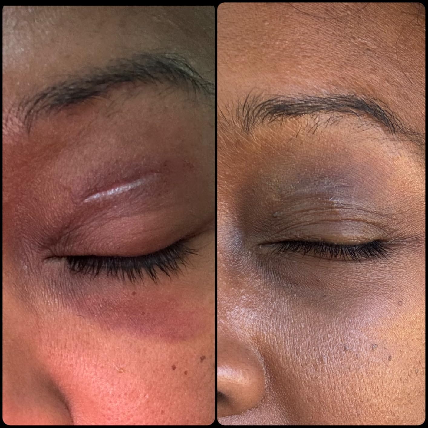 Customer photo review of Advanced Scar Repair Cream – Smooth & Improve the Appearance of Scars