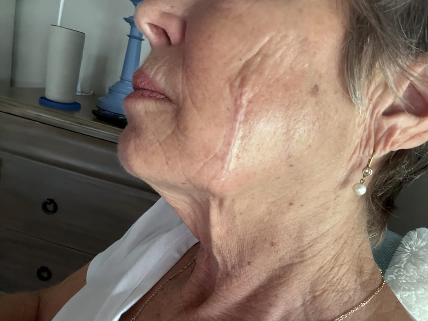 Customer photo review of Advanced Scar Repair Cream – Smooth & Improve the Appearance of Scars