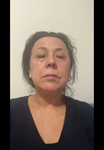 Reviewer showing her face to document the results of the Seranova Micro Infusion System.