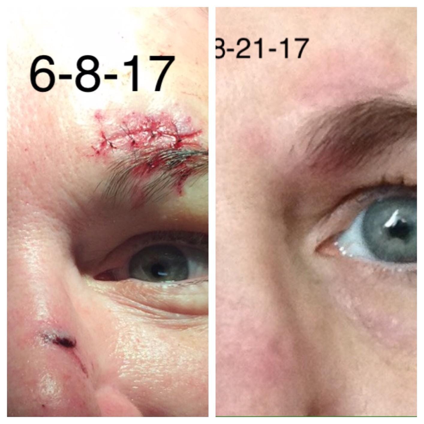Customer photo review of Advanced Scar Repair Cream – Smooth & Improve the Appearance of Scars
