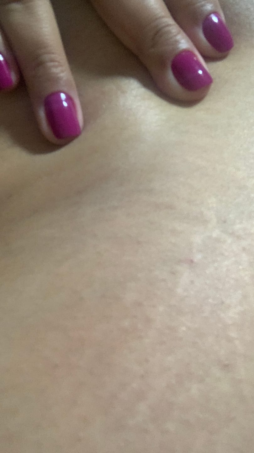 Customer photo review of Creme Antiestrias Regenerador Dérmico