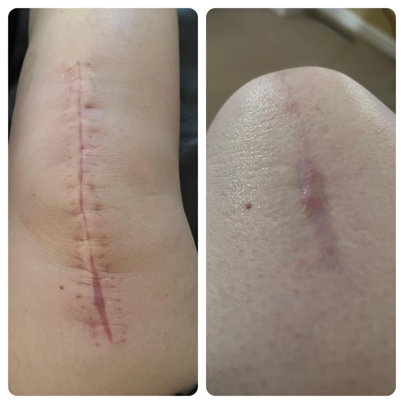 Customer photo review of Advanced Scar Repair Cream – Smooth & Improve the Appearance of Scars