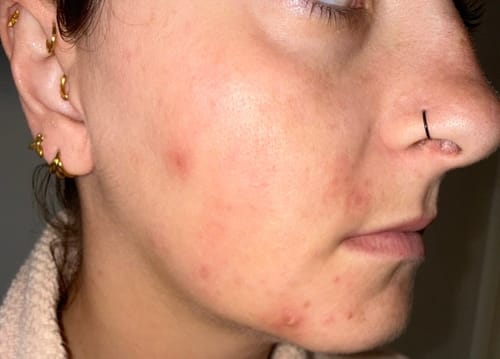 Close-up of a reviewer's face with red acne before using the Intermediate Acne Program™.