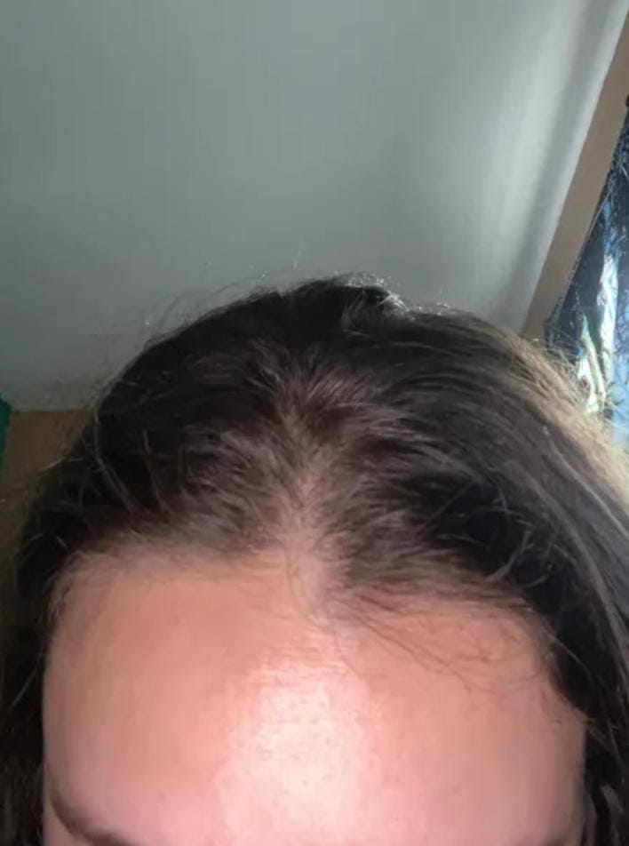 Customer photo review of Spray de Aceite para el Crecimiento del Cabello
