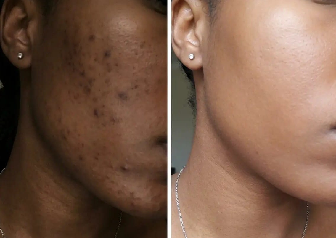 Customer photo review of Shimma™ Arbutin 7% + Txa Acid 4% Cream