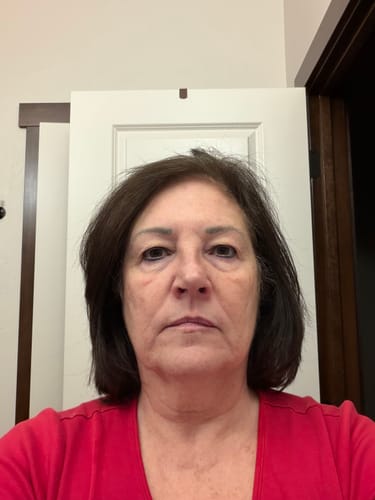 Customer's 'before' photo showing her skin prior to using The Micro Infusion System.