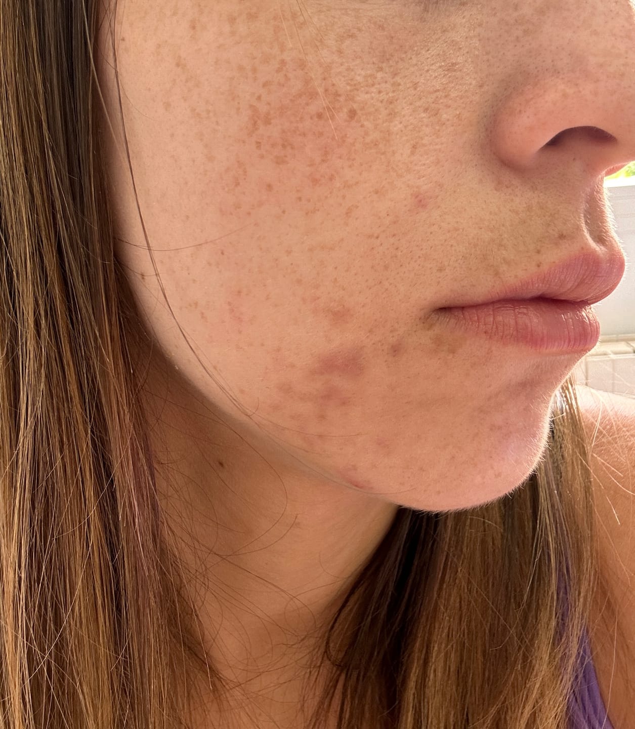 Customer photo review of A CONTROL - ACNÉ HORMONAL & RESISTENCIA A LA INSULINA
