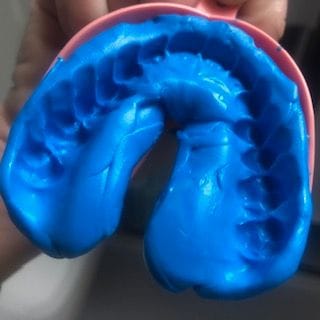 Customer photo review of Custom Clear Removable Retainers