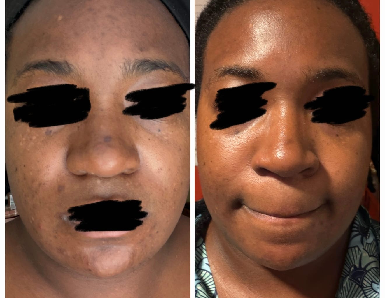 Customer photo review of Melanin Skin Bundle