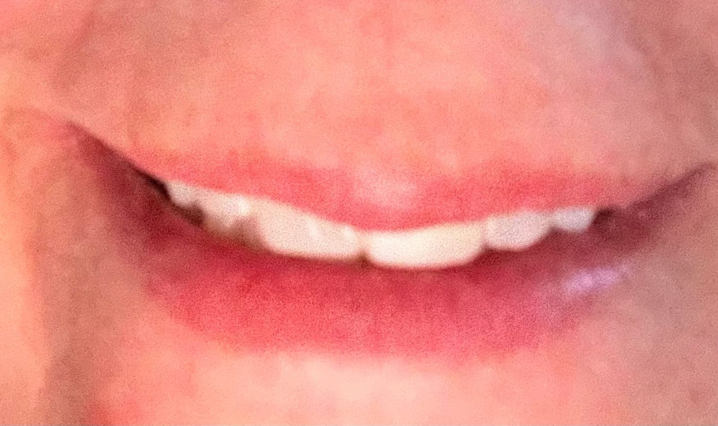 Customer photo review of Night Guard Cleaning + Teeth Whitening Foam