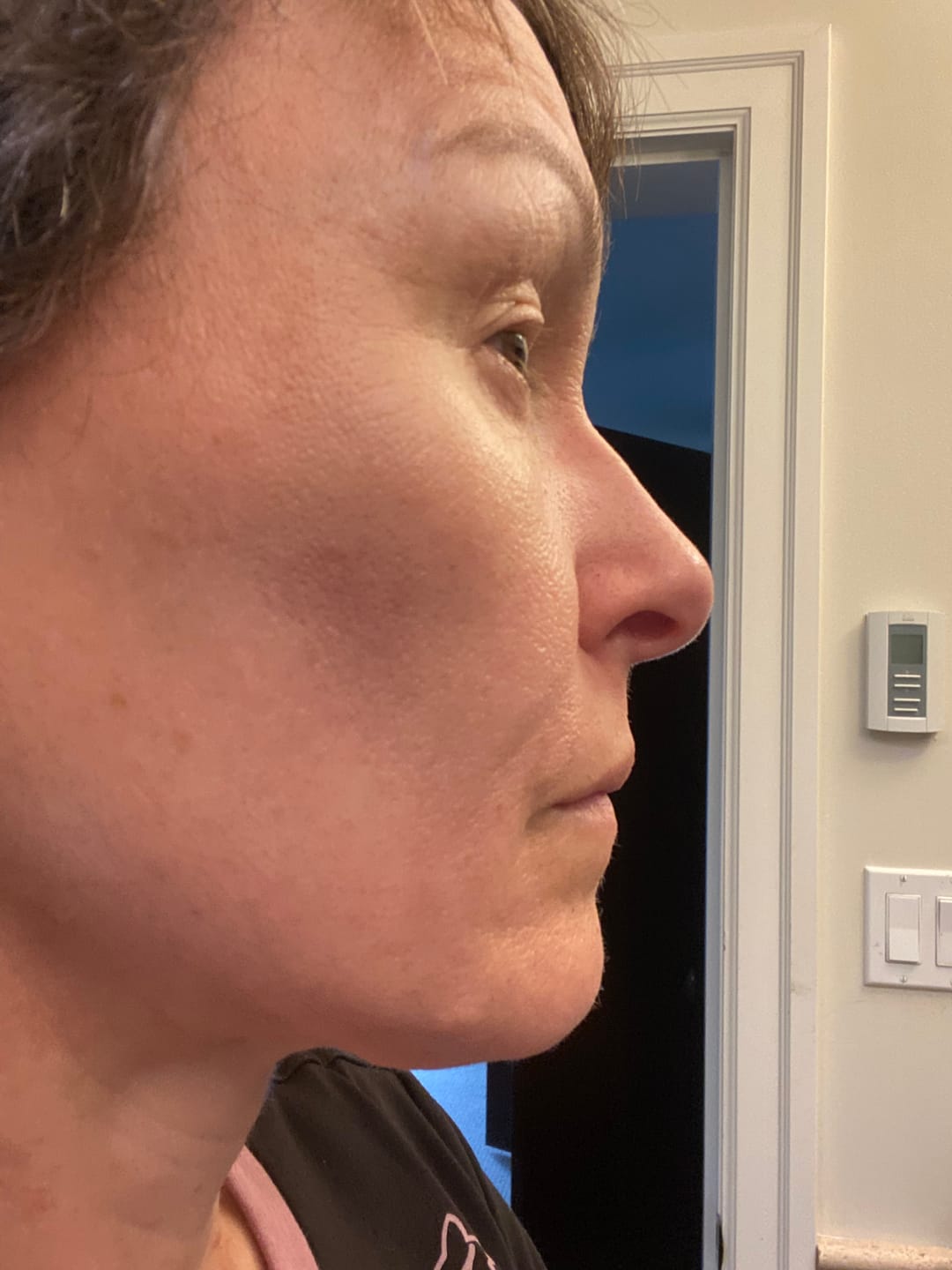 Customer photo review of 3 Month Supply - Seranova Micro Infusion System