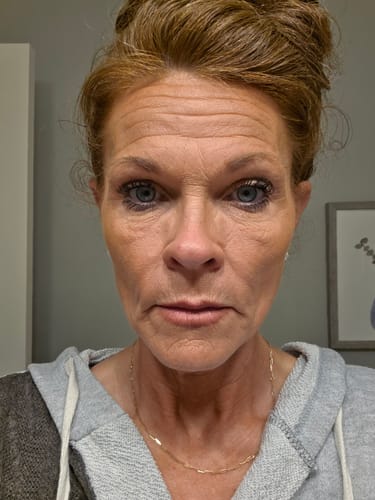 Customer's face before using the Seranova Micro Infusion System, showing visible lines on forehead and under eyes.