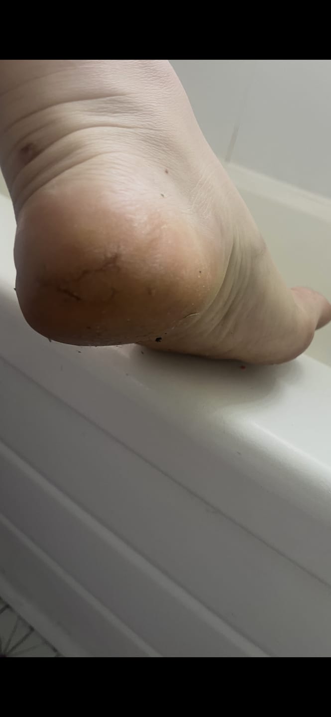 Customer photo review of Heel Care Cream