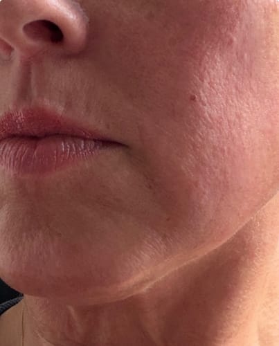 Close-up of a customer's cheek, showing skin texture after using the Seranova Micro Infusion System.