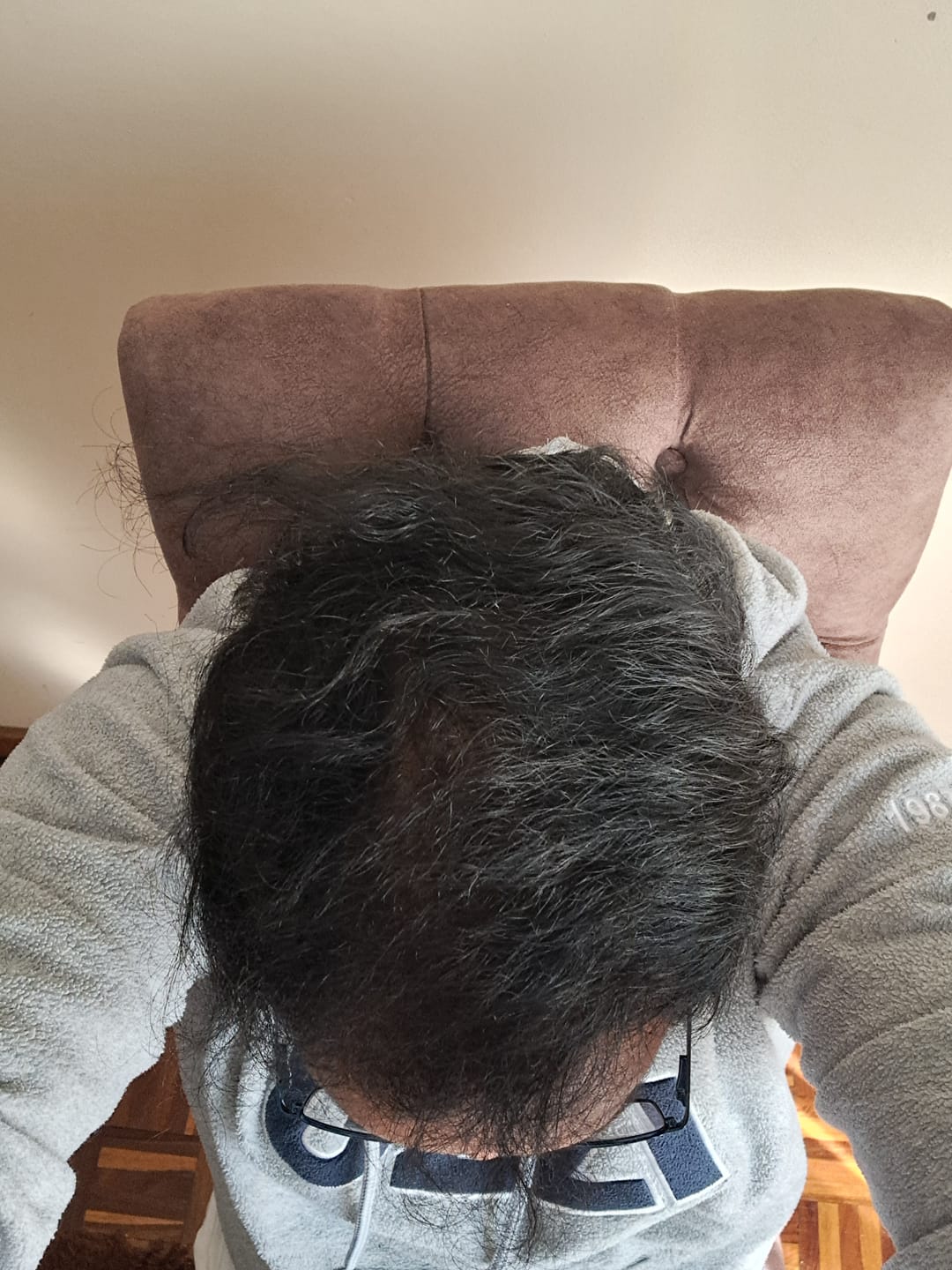 Customer photo review of Minoxidil 5% + DHT Blocker Solution - MEN ONLY, 3 Month supply
