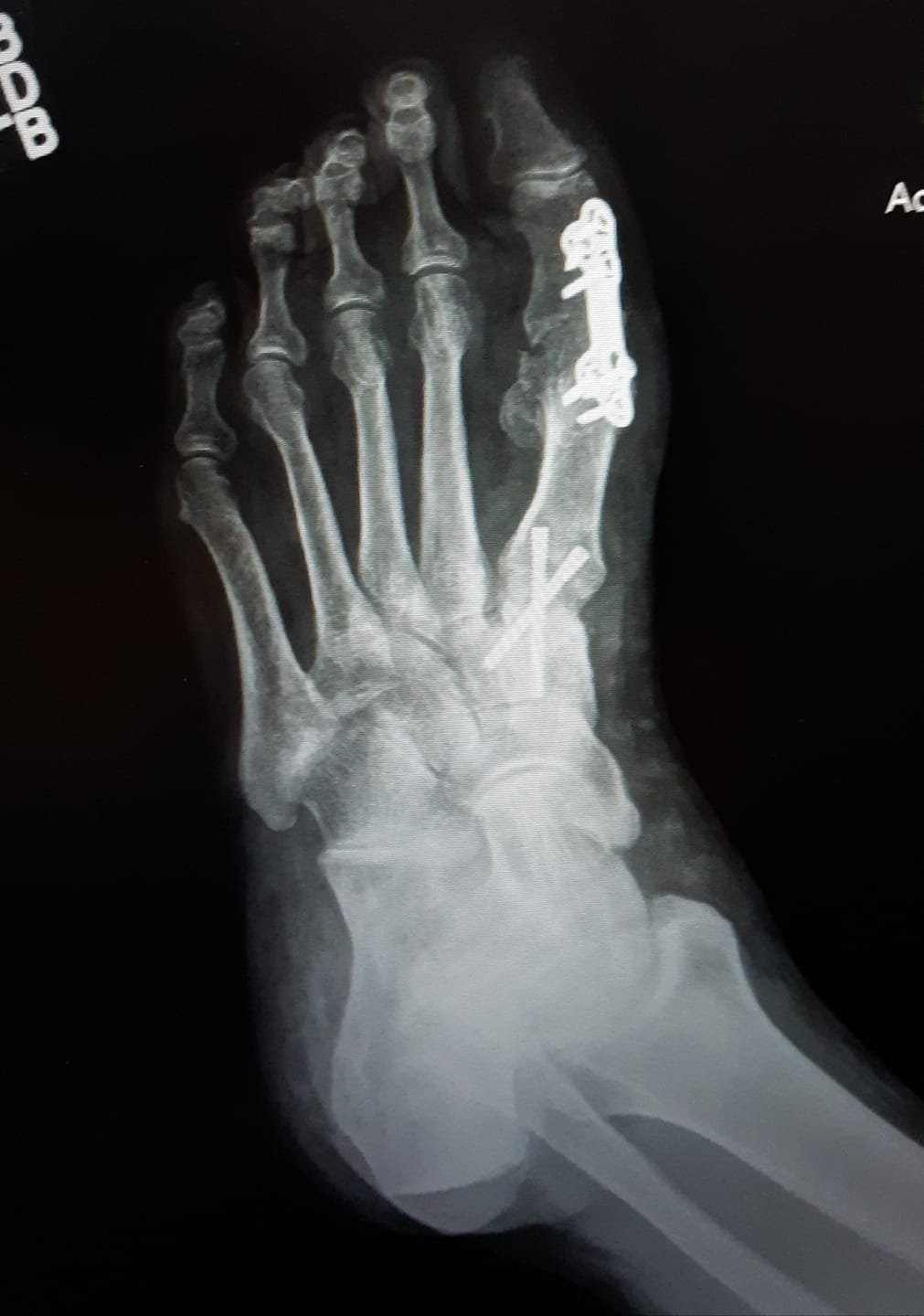 Customer photo review of Black Model / Plantar fasciitis