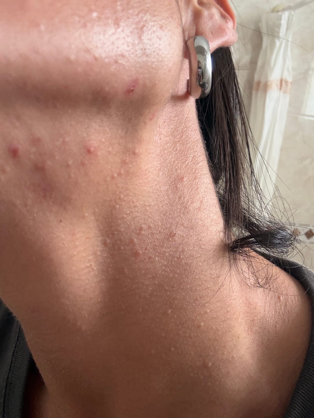 Customer photo review of A CONTROL - ACNÉ HORMONAL & RESISTENCIA A LA INSULINA