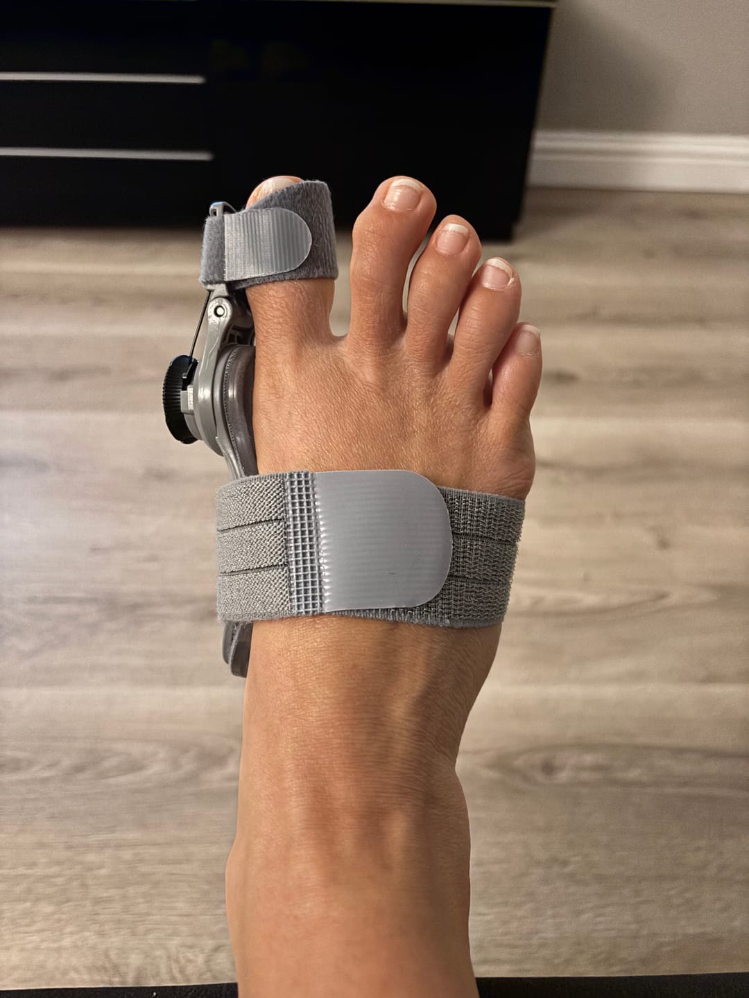 Customer photo review of Treatmedy™ Bunion Fix