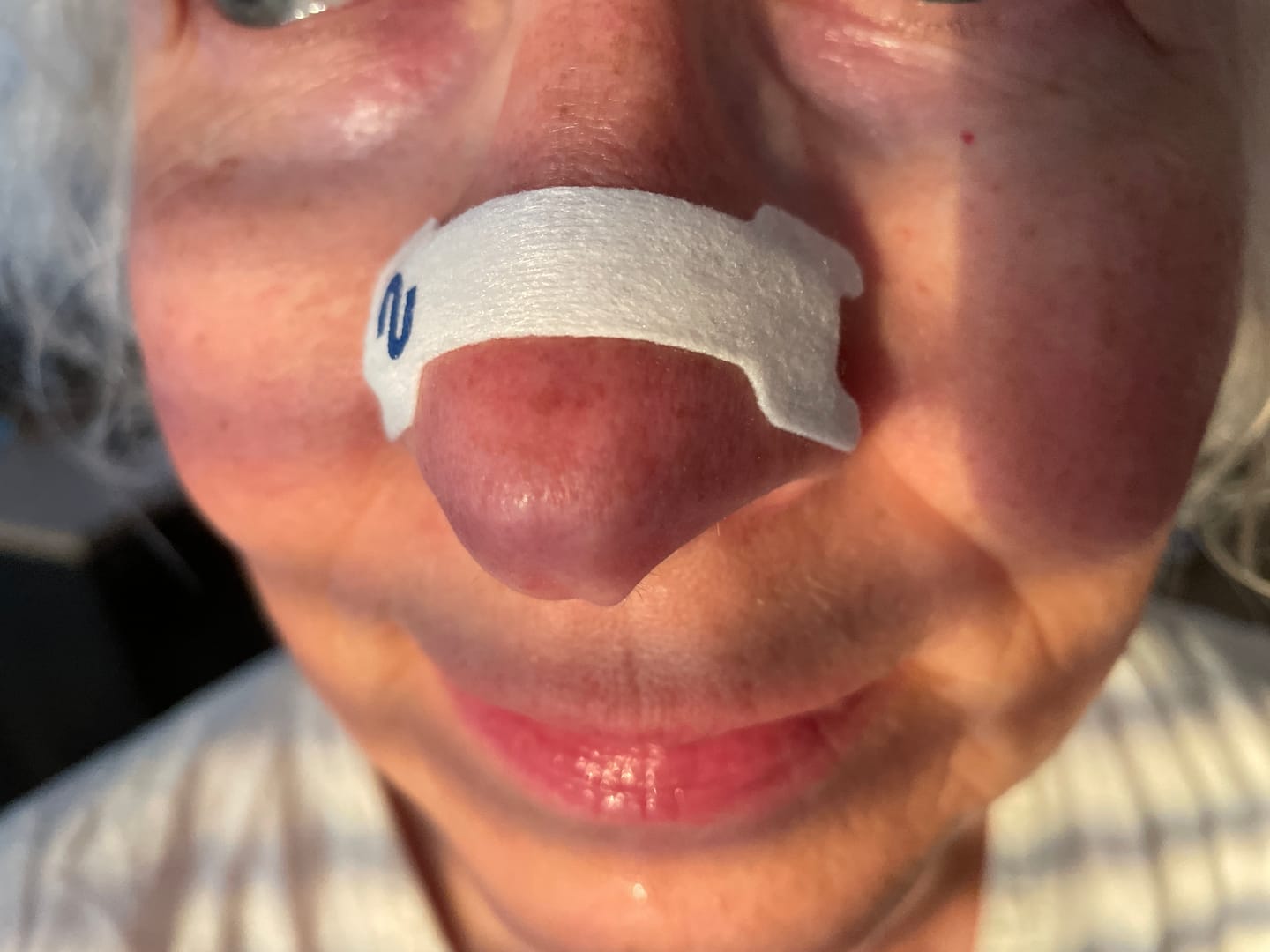 Customer photo review of Nuku Sleep Nasal Strips
