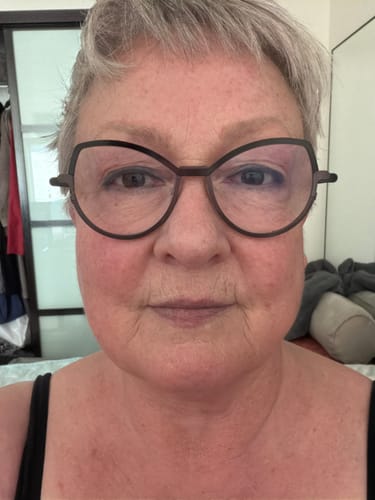 Customer's close-up photo showing smoother skin around the mouth and forehead after using The Micro Infusion System.