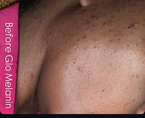 Customer's close-up view of facial skin with dark spots before using GLO MELANIN products.
