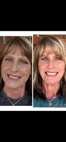 Reviewer's before-and-after image showing smoother-looking skin after using Koriderm™ Time Reverse Cream.