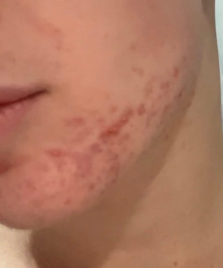Customer photo review of Helloskin GHK-Cu 1% Triple-Peptide Regenerative Serum
