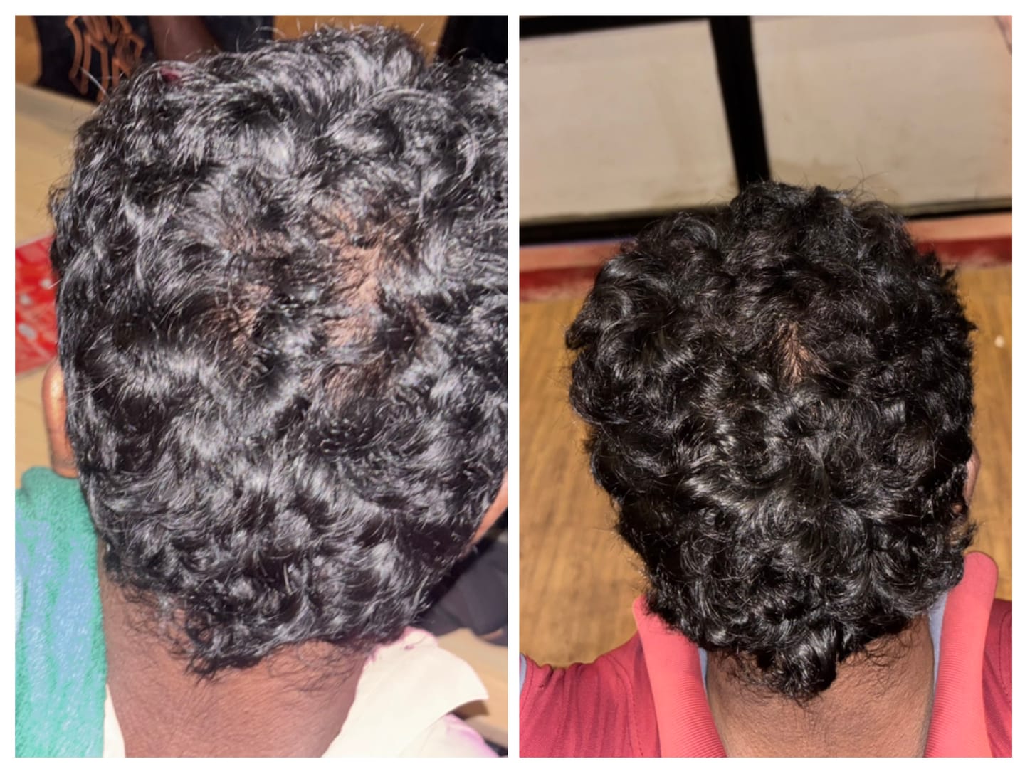 Customer photo review of Advance Hair Growth Serum 2.0 (30ml)