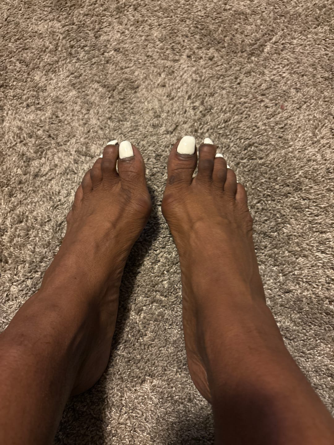 Customer photo review of Treatmedy™ Bunion Fix - Natural At-Home Bunion Relief