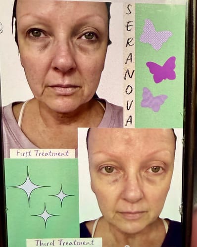 Reviewer's before-and-after collage showing improved, smoother skin after using the Micro Infusion System.