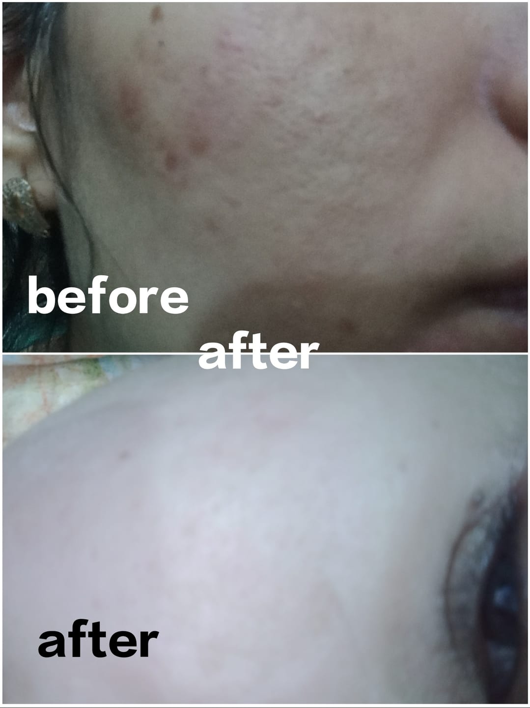 Customer photo review of NiaRonic Serum (Pore Minimizing)