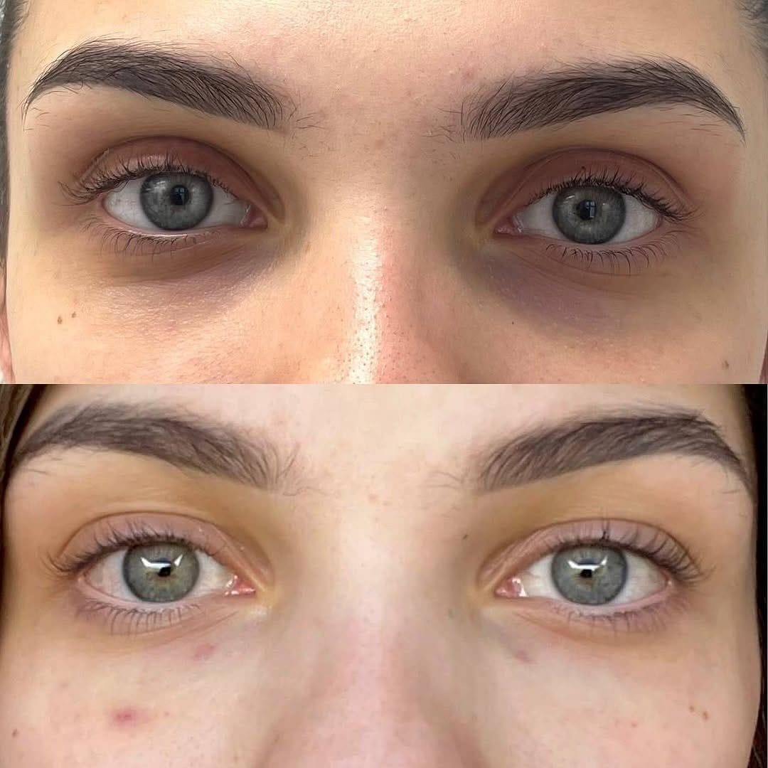 Customer photo review of סרום רולר משקם של NOVELA להפחתת כהויות, שקיות וקמטים