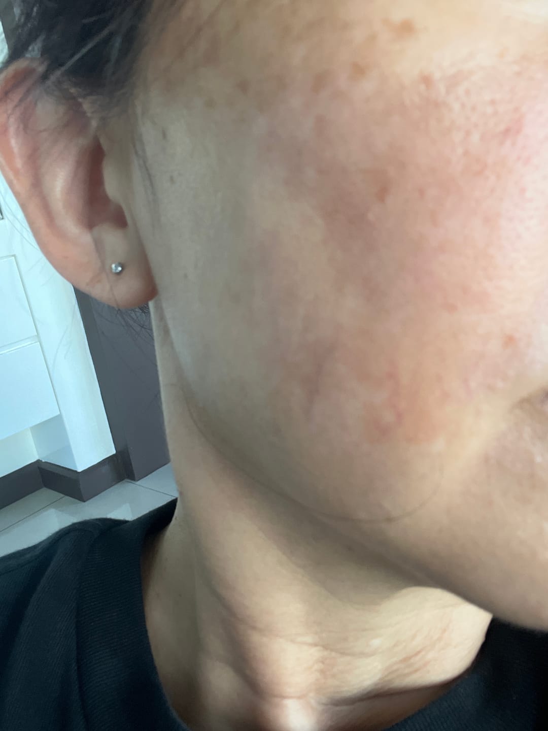 Customer photo review of Ventamin Light Up: Doctor-Formulated Brightening Formula for Melasma, Acne scars & Hyperpigmentation