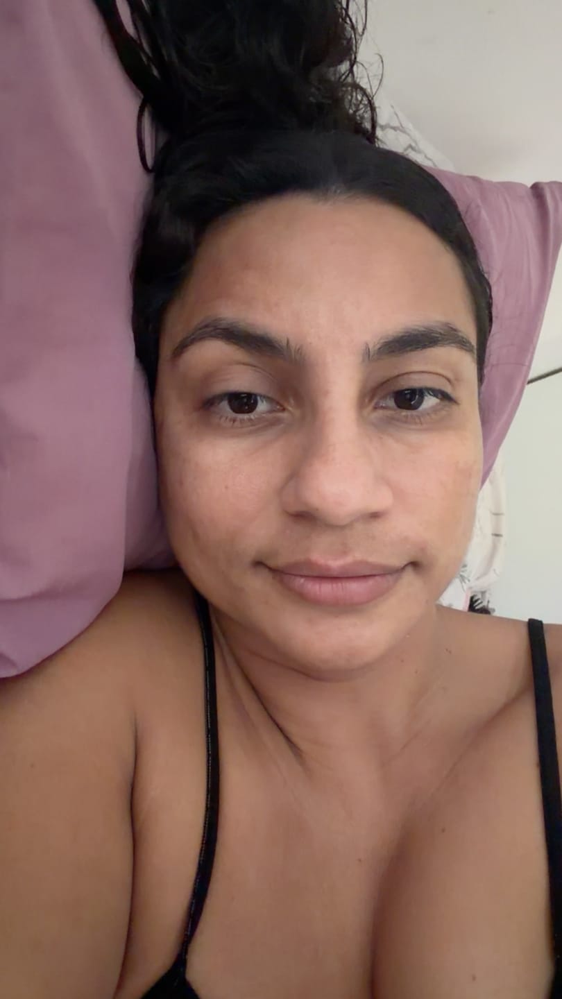 Customer photo review of Solução Exossomos + PDRN + Peptídeos