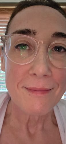 Customer's close-up photo showing smooth skin after using the Seranova Micro Infusion System.