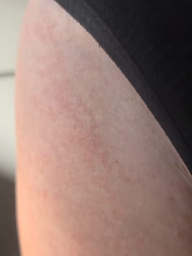 Customer's close-up of a red, bumpy rash on their bikini line before using the Healing Intimate Oil.