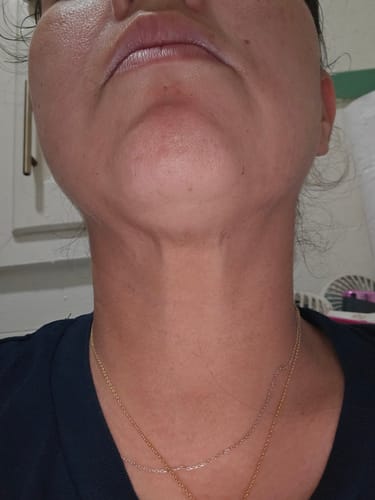 Customer shows neck skin in first progress photo using the Seranova Micro Infusion System.