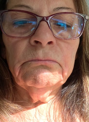 Close-up of a reviewer's face before using the Seranova Micro Infusion System, showing lines around the mouth and chin.