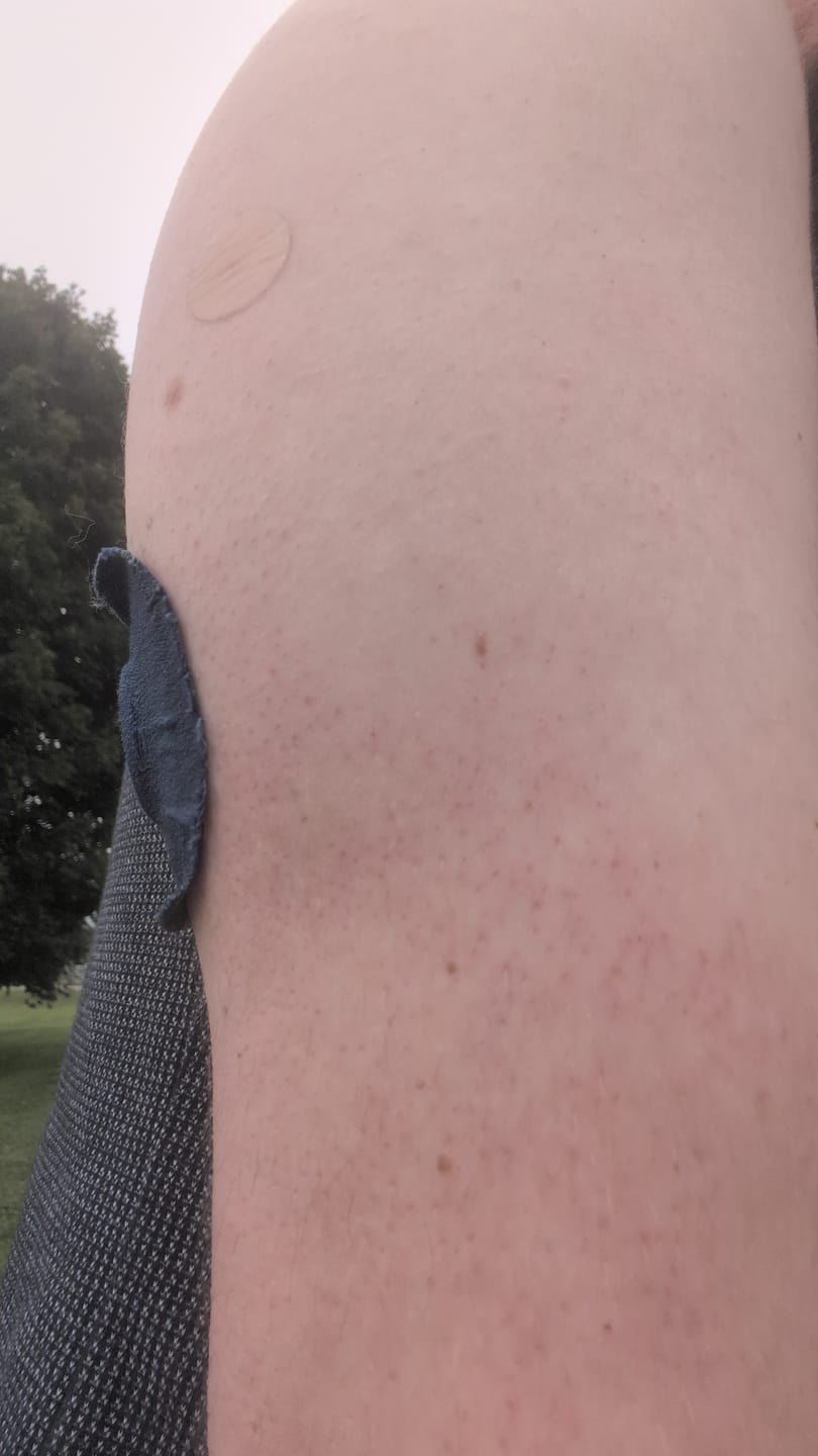 Customer photo review of Skin Grip Original - Dexcom G7 & Stelo Adhesive Patches