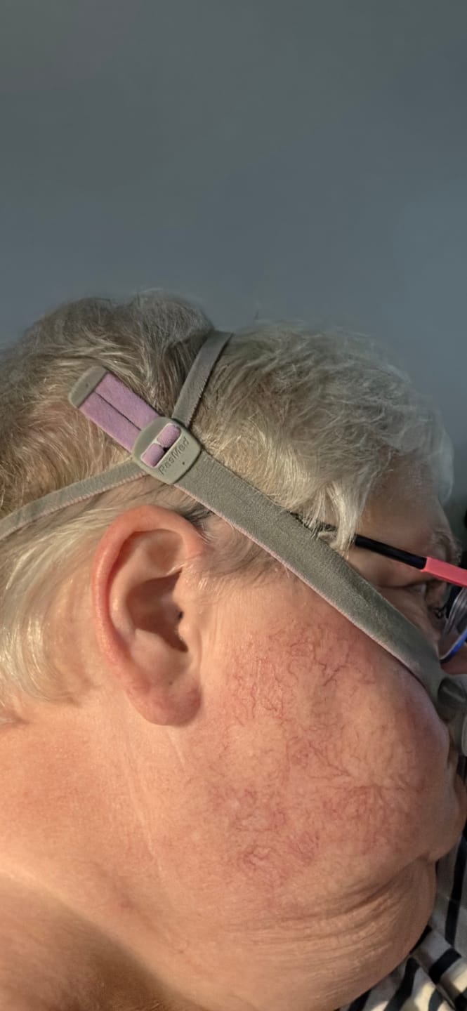 Customer photo review of ResMed AirFit™ F40 Full-Face Mask Complete System